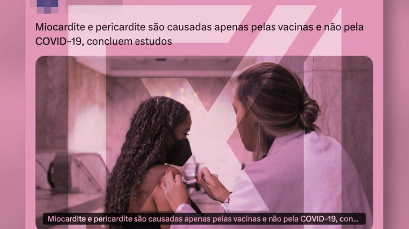 Miocardite e pericardite sÃ£o condiÃ§Ãµes caracterizadas pela inflamaÃ§Ã£o do mÃºsculo cardÃ­aco e inflamaÃ§Ã£o do revestimento externo do coraÃ§Ã£o 